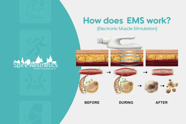 EMS treatment for post pregnancy weight loss treatment Cambridge