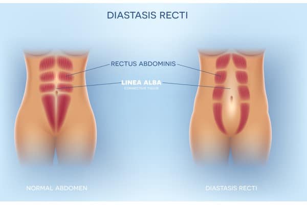 What Non-Surgical Options Are Available for Diastasis Recti Cambridge?