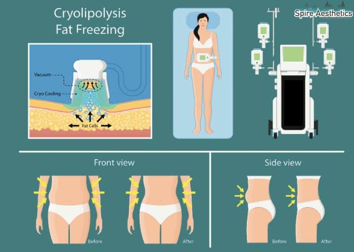 Image of diet and fat freezing combined for best results for Spire Aesthetics Cambridge