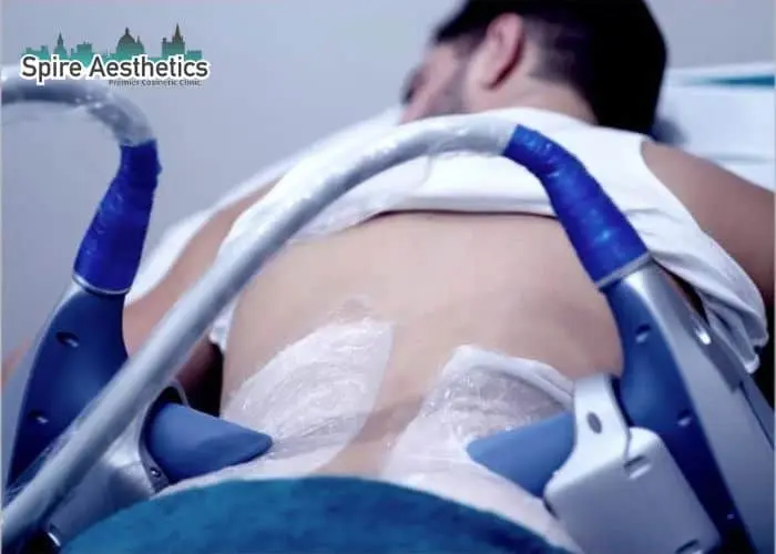 Man having fat freezing treatment done on love handles before a competitions Cambridge to create a sculpted look.