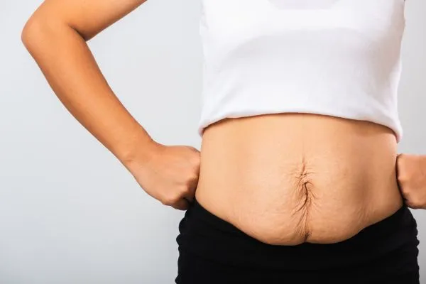 Image of a woman's stomach after weight loss with sagging skin following a gastric band Cambridge