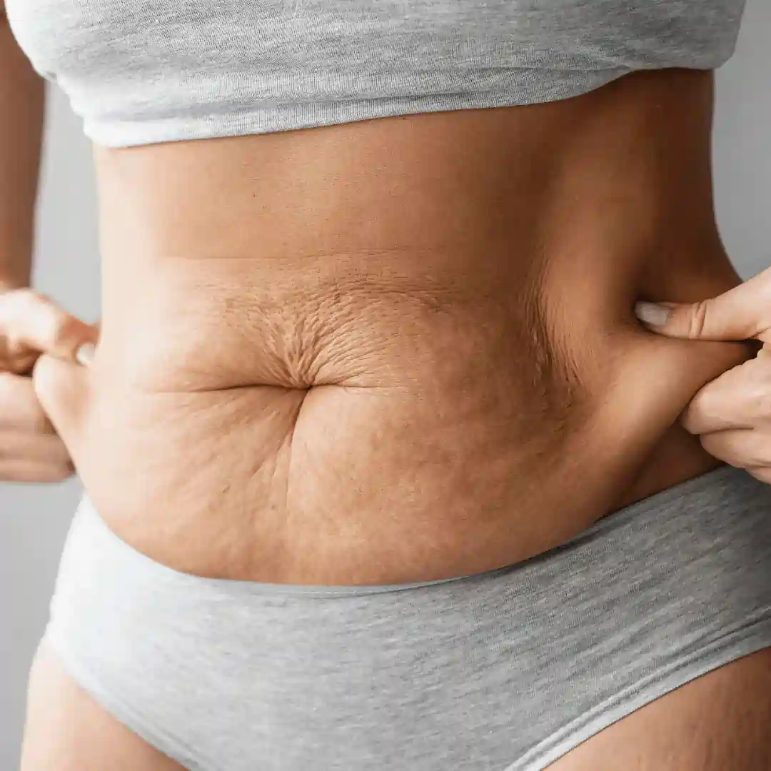 Is It Normal to Have Loose Skin After Pregnancy Cambridge?