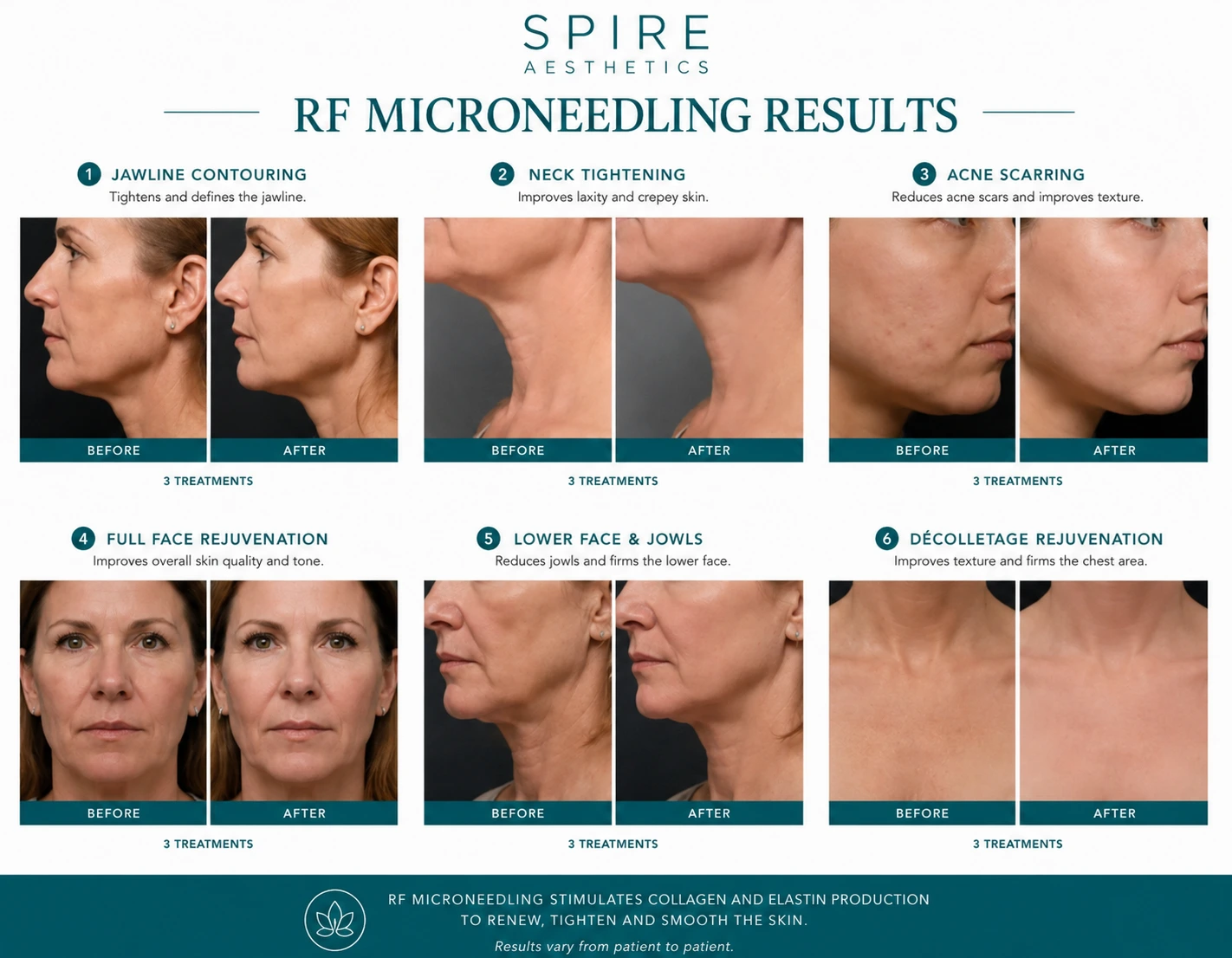 RF Microneedling Skin tightening Cambridge results
