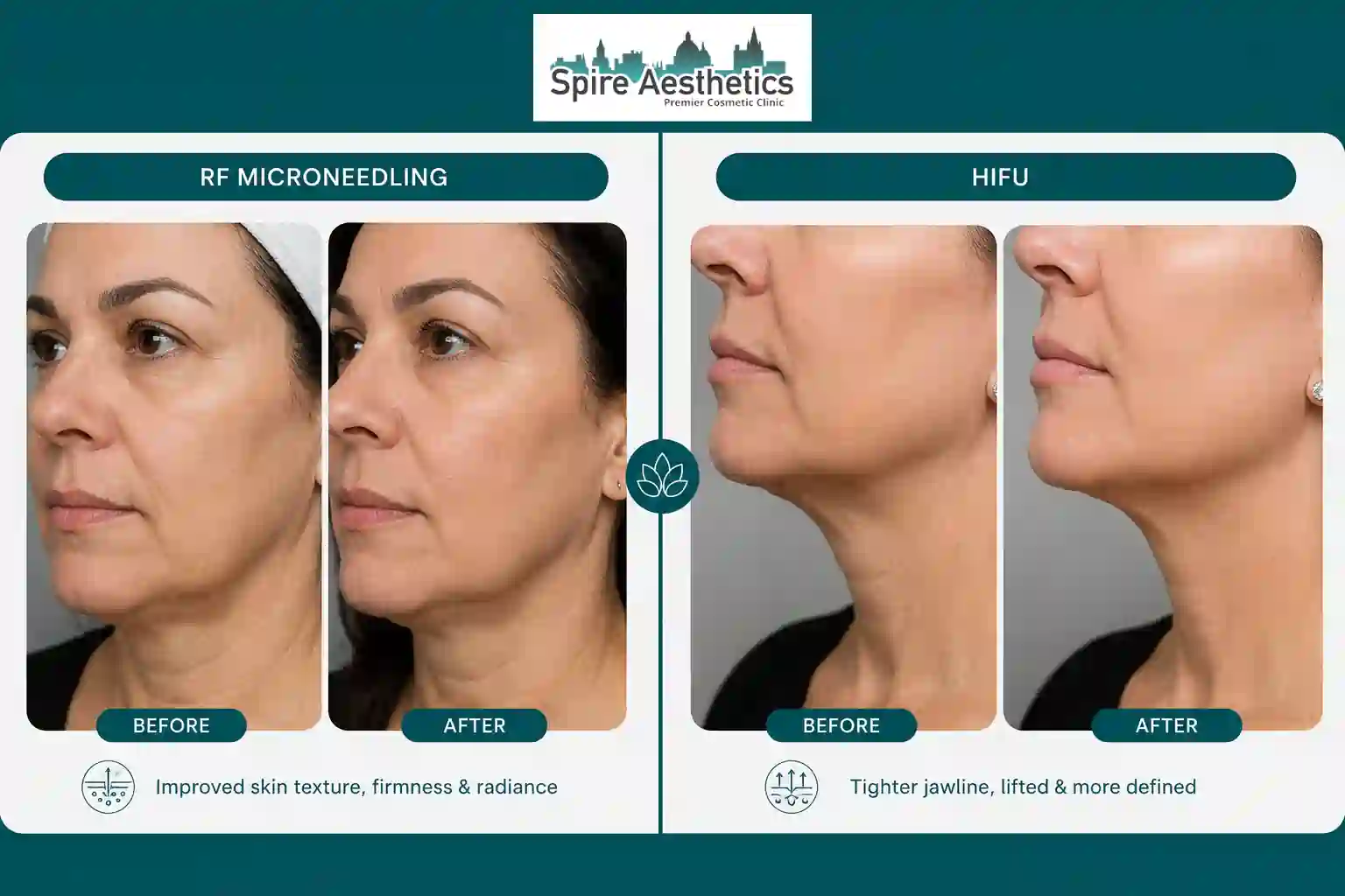 Can RF Microneedling and HIFU Be Combined Cambridge?