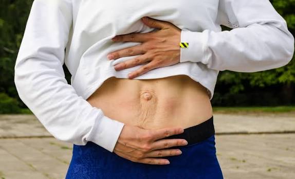 When Could Diastasis Recti Be the Missing Piece of the Puzzle Cambridge?