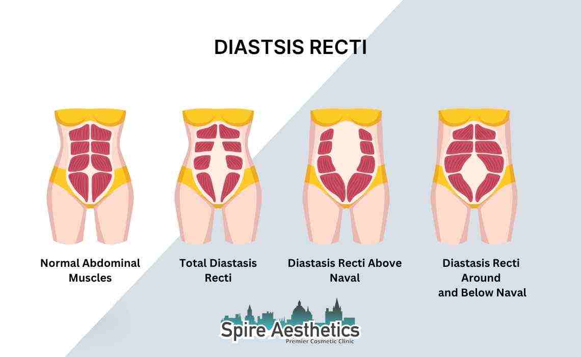 Is Non-Surgical Diastasis Recti Treatment Right for You? Common Concerns Answered Cambridge